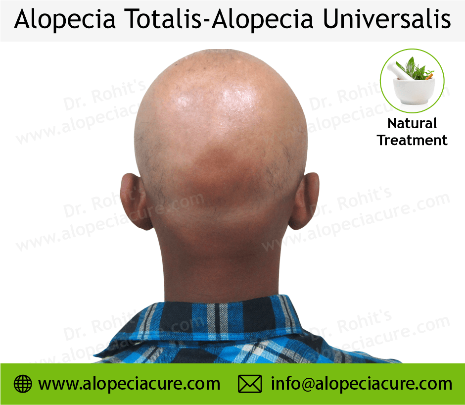 Alopecia Universalis