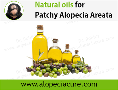 Dr. Rohit's natural oil treatment for  alopecia areata