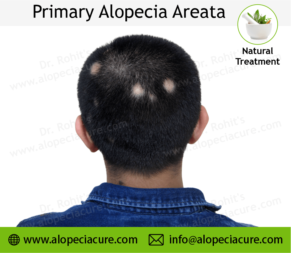 Primary Alopecia Areata
