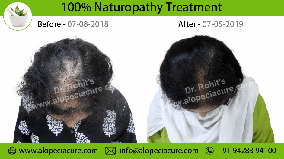 female hair loss treatment