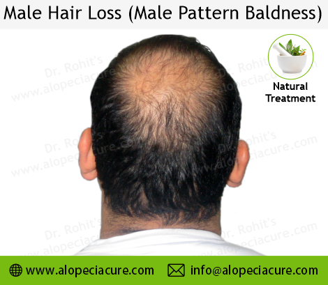 male hair loss