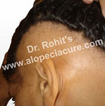 Ophiasis Alopecia Areata