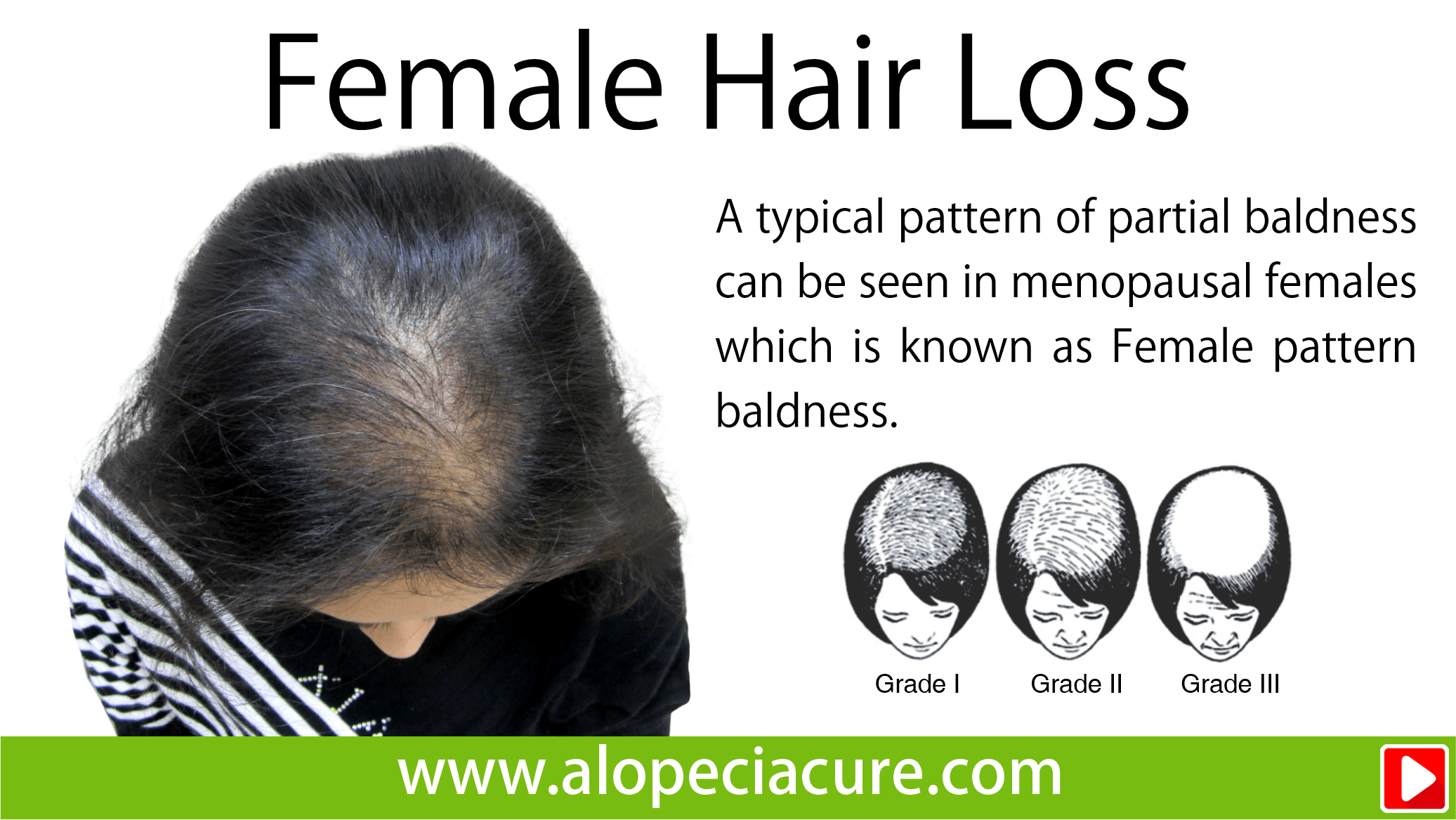 female hair loss treatment